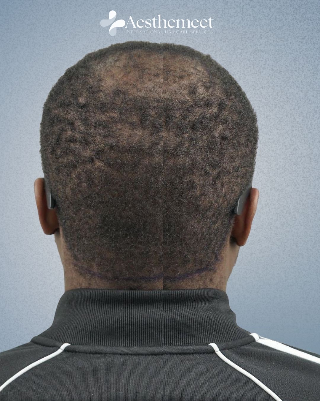 Donor area assessment and preservation planning before hair transplant at Aesthemeet
