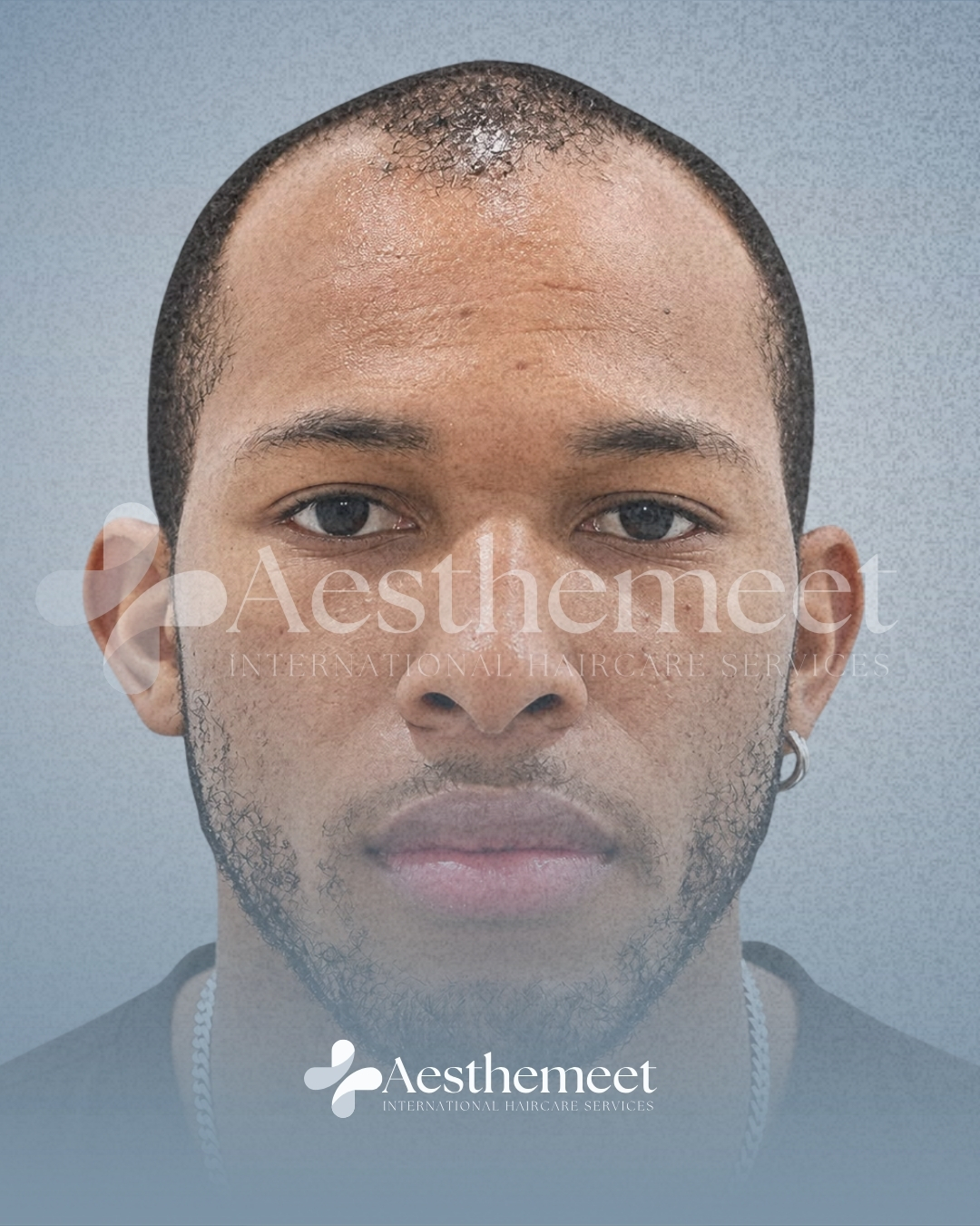 Patient 01 before hairline restoration