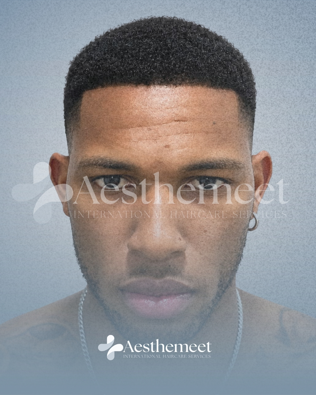 Patient 01 follow-up after hairline restoration