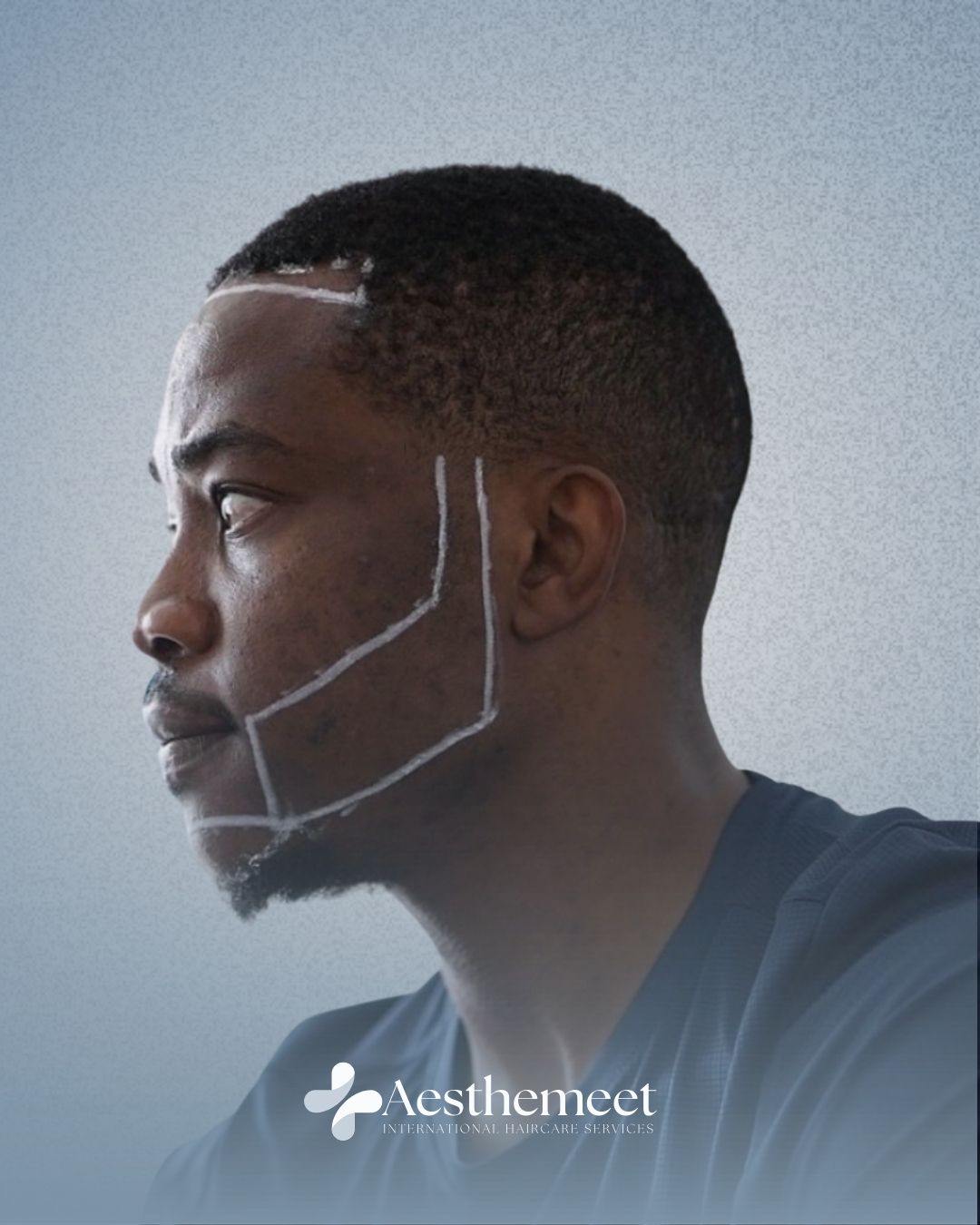 Beard transplant treatment at Aesthemeet